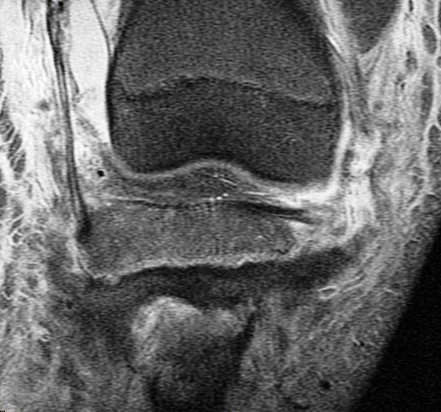 Figure 4 for case Salter type IV fracture ( RID4688 )